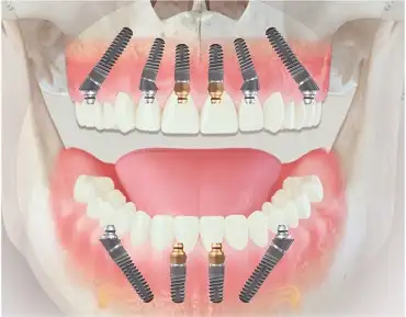 Tehnica All-on-4 implant dentar – 4 implanturi arcadă completă