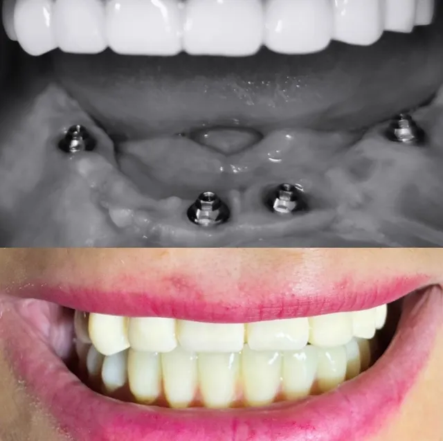 Implant Dentar & Proteză Fixă – Înainte și După – DentAtelier Timișoara