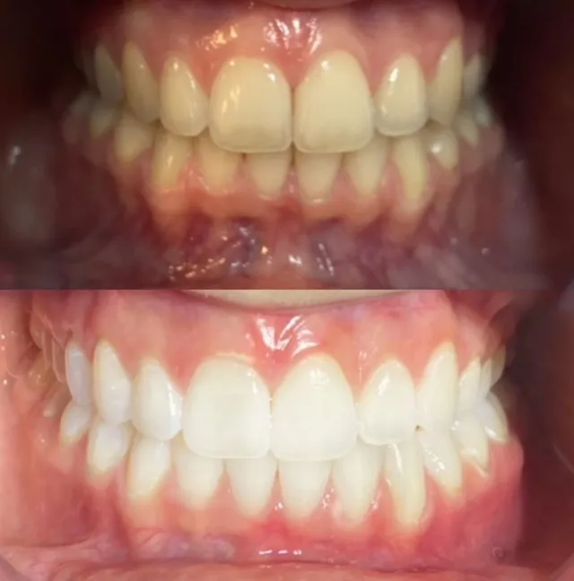 Albire & Bonding Dentar – Înainte și După – DentAtelier Timișoara
