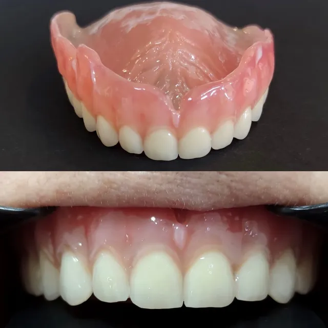 Proteză Totală Superioară – Înainte și După – DentAtelier Timișoara