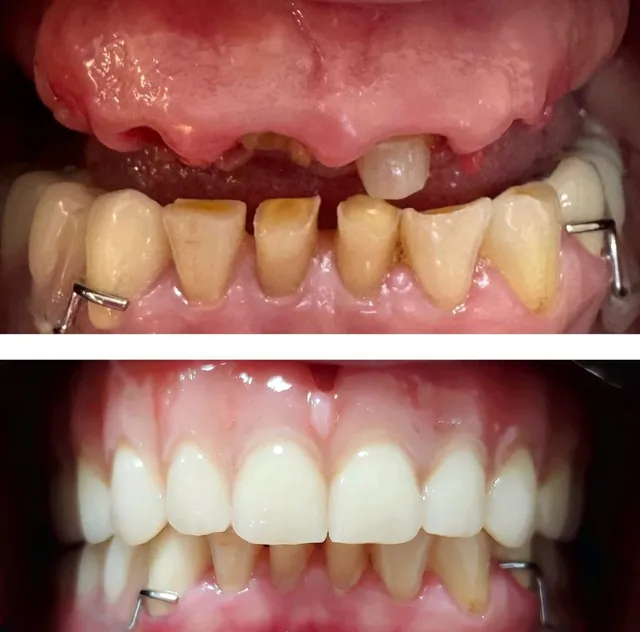 Reabilitare Completă – Înainte și După – DentAtelier Timișoara