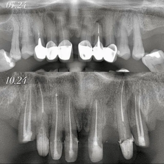 Tratament Endodontic Complex – Înainte și După – DentAtelier Timișoara