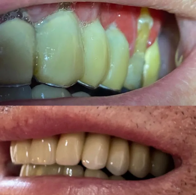 Proteză pe Implanturi – Înainte și După – DentAtelier Timișoara