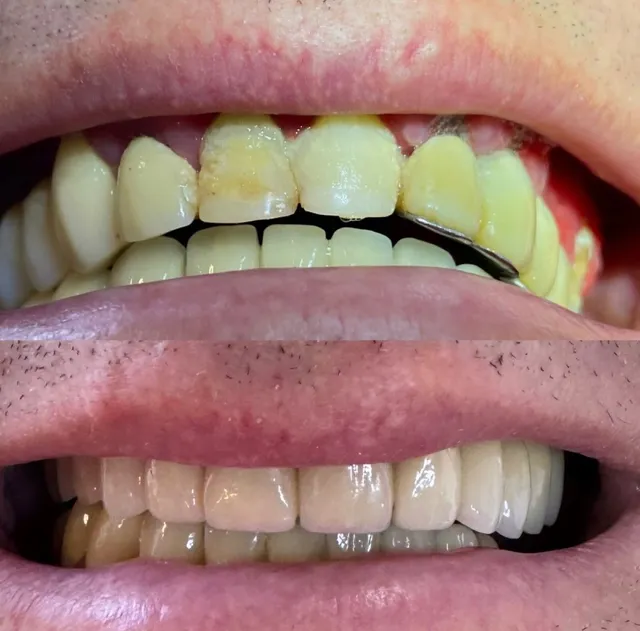 Coroane Dentare Ceramice – Înainte și După – DentAtelier Timișoara