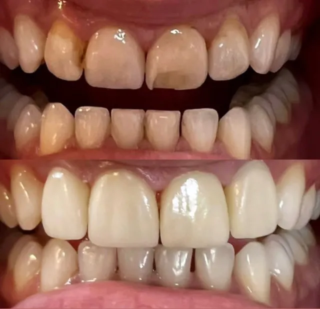 Estetică Dentară – Înainte și După – DentAtelier Timișoara