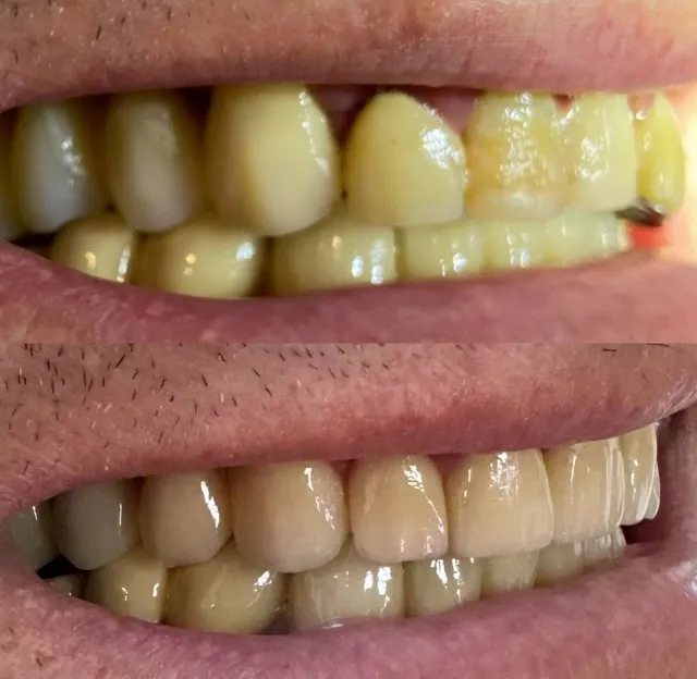 Proteză Fixă pe Implanturi – Înainte și După – DentAtelier Timișoara