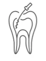 Tratament de Canal – serviciu stomatologic DentAtelier Timișoara