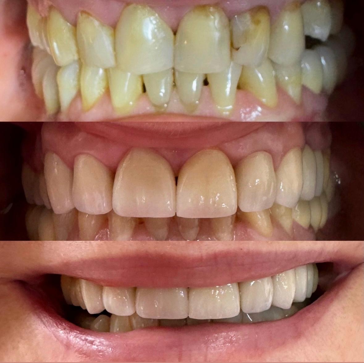 Fatete dentare – transformare estetica a zambetului – DentAtelier Timisoara