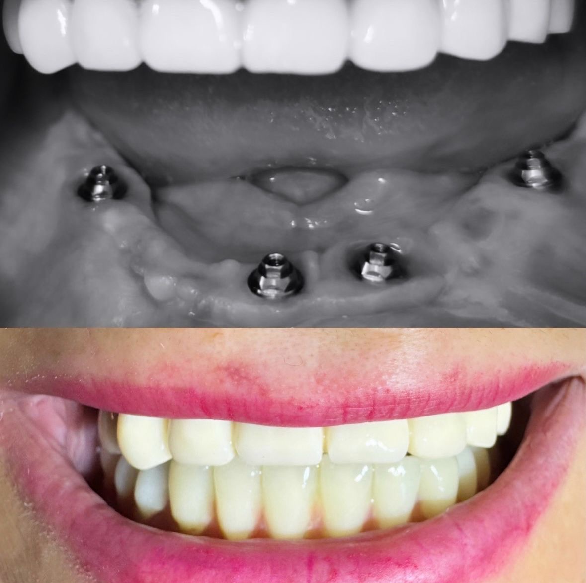 Implant dentar si proteza fixa – reconstructie completa pe implanturi – DentAtelier Timisoara