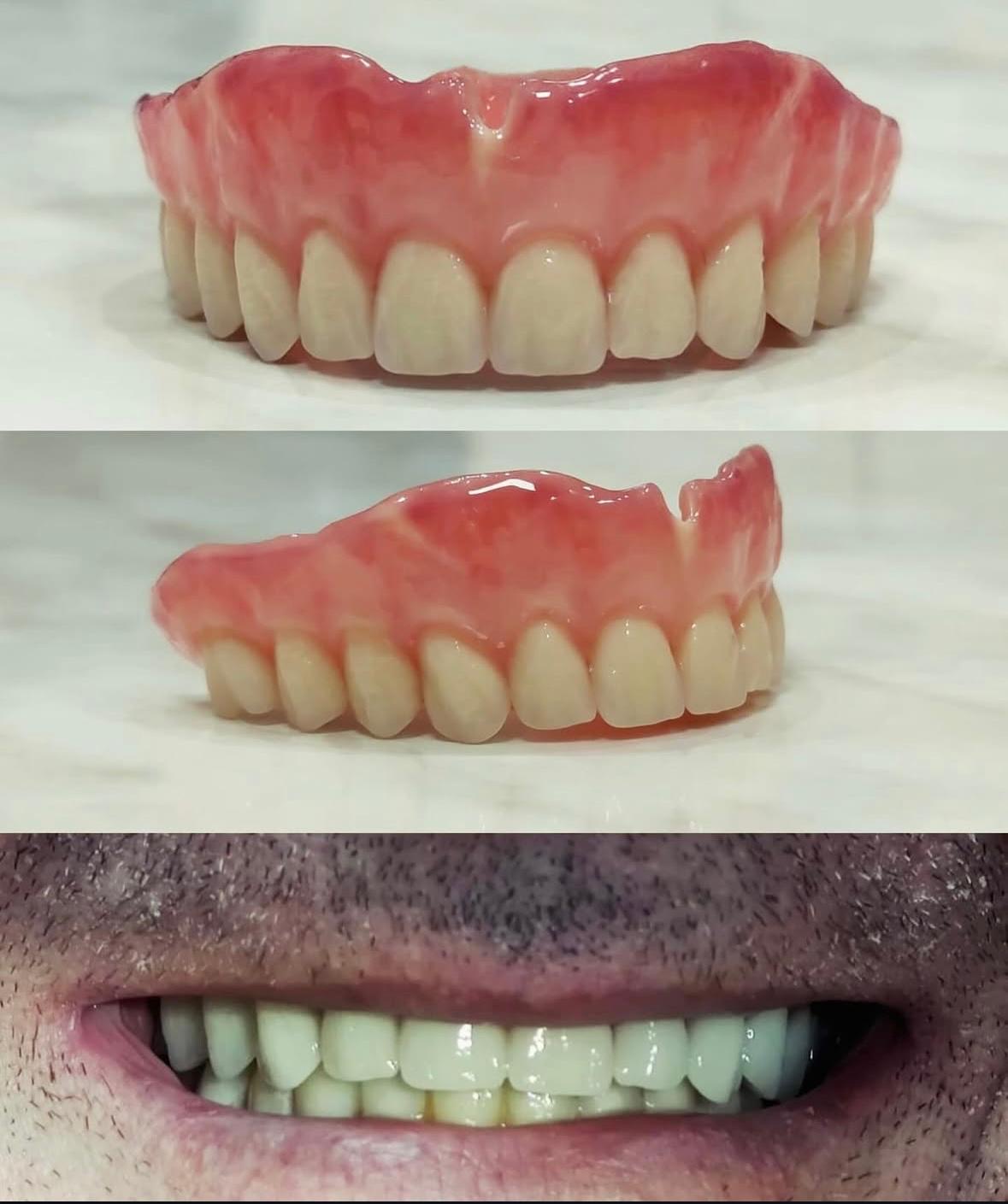 Proteza mobilizabila – proteza totala cu rezultat natural – DentAtelier Timisoara