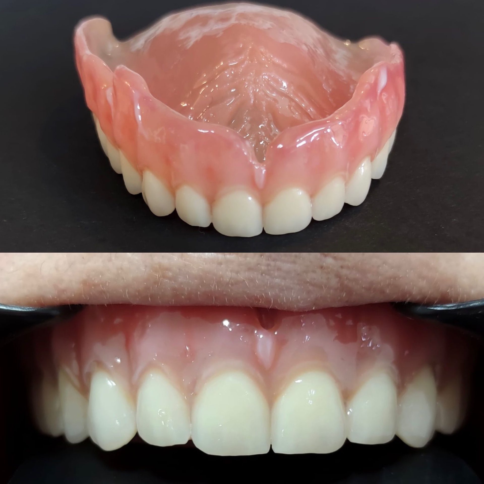 Proteza totala superioara – proteza si rezultat final – DentAtelier Timisoara