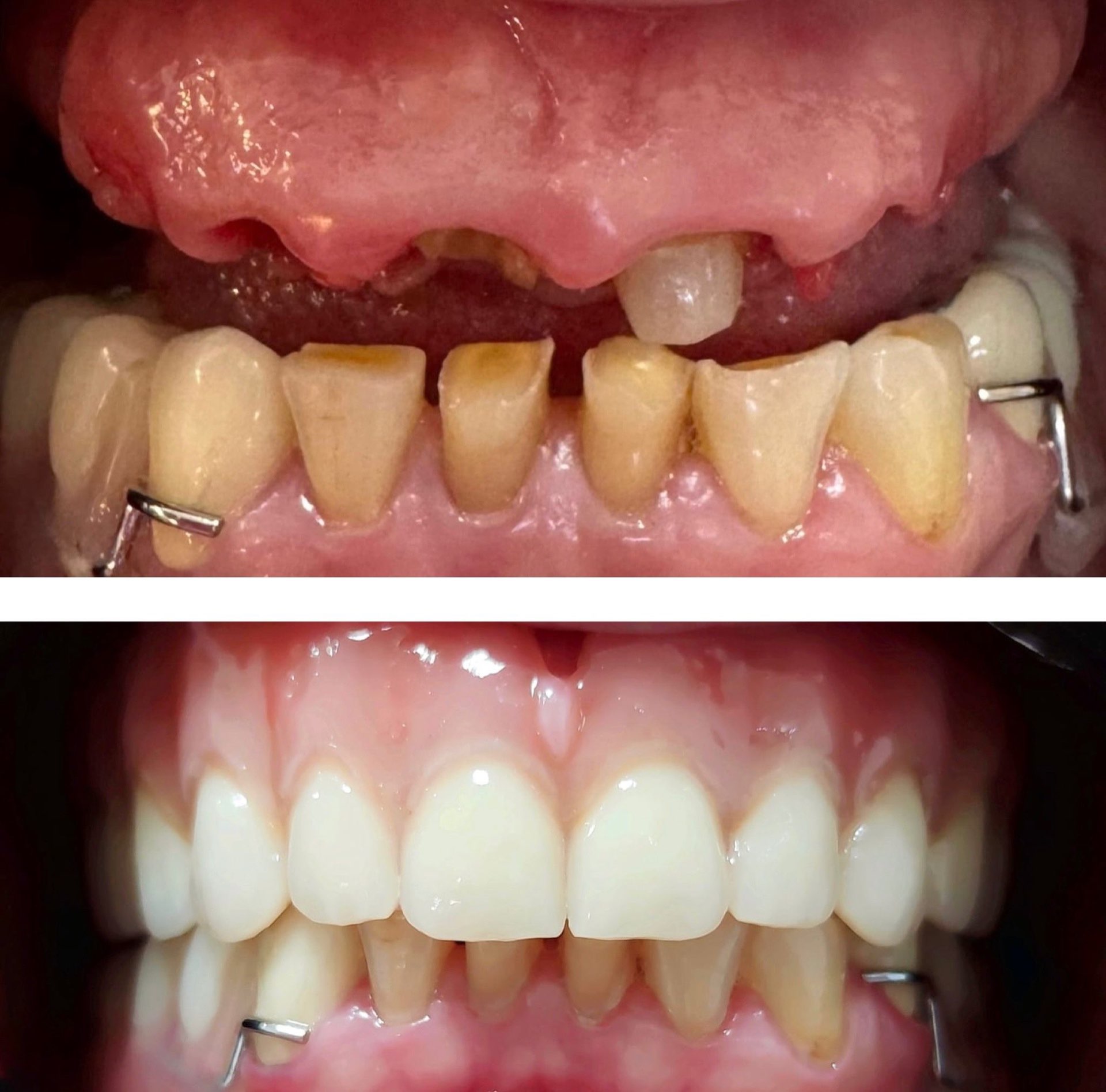 Reabilitare completa – transformare estetica inainte si dupa – DentAtelier Timisoara