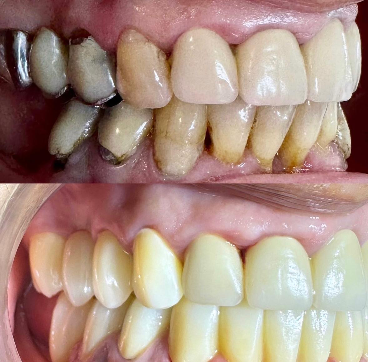 Reabilitare orala complexa – inlocuire punti vechi cu lucrari noi – DentAtelier Timisoara