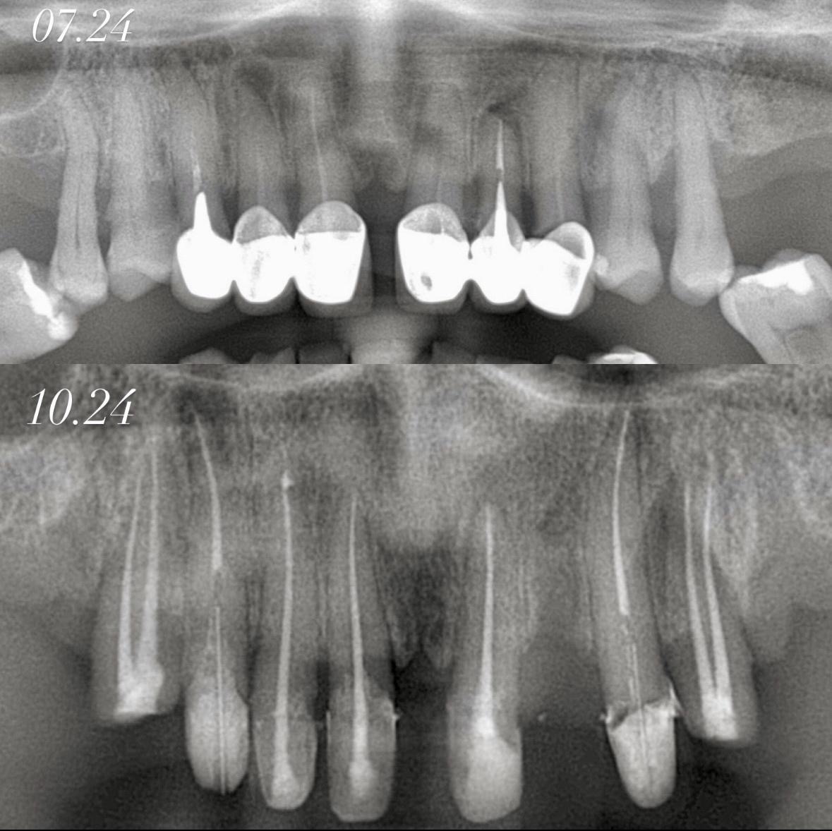Tratament endodontic complex – radiografie inainte si dupa tratament canal – DentAtelier Timisoara